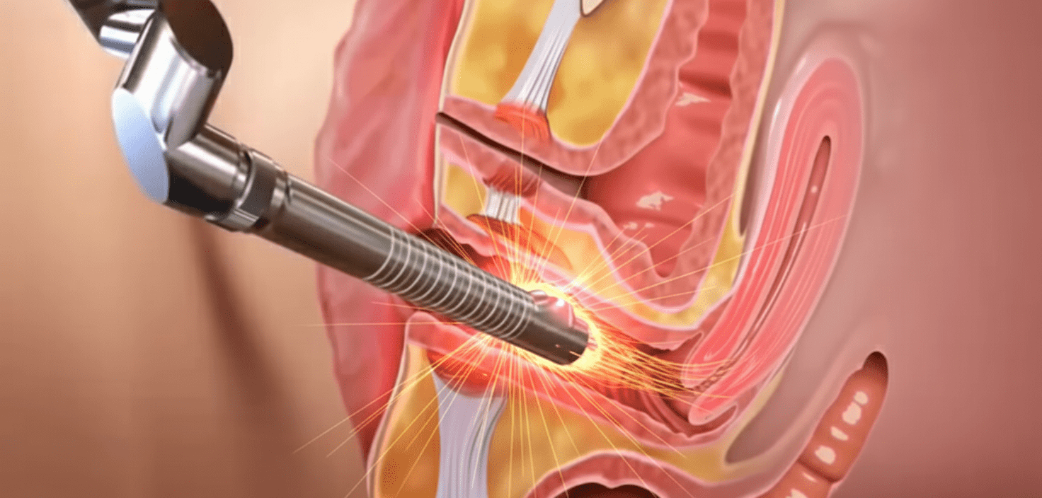 آر اف واژن در اصفهان