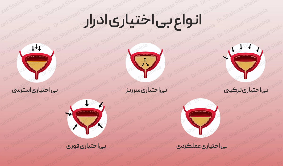 انواع بی اختیاری ادرار